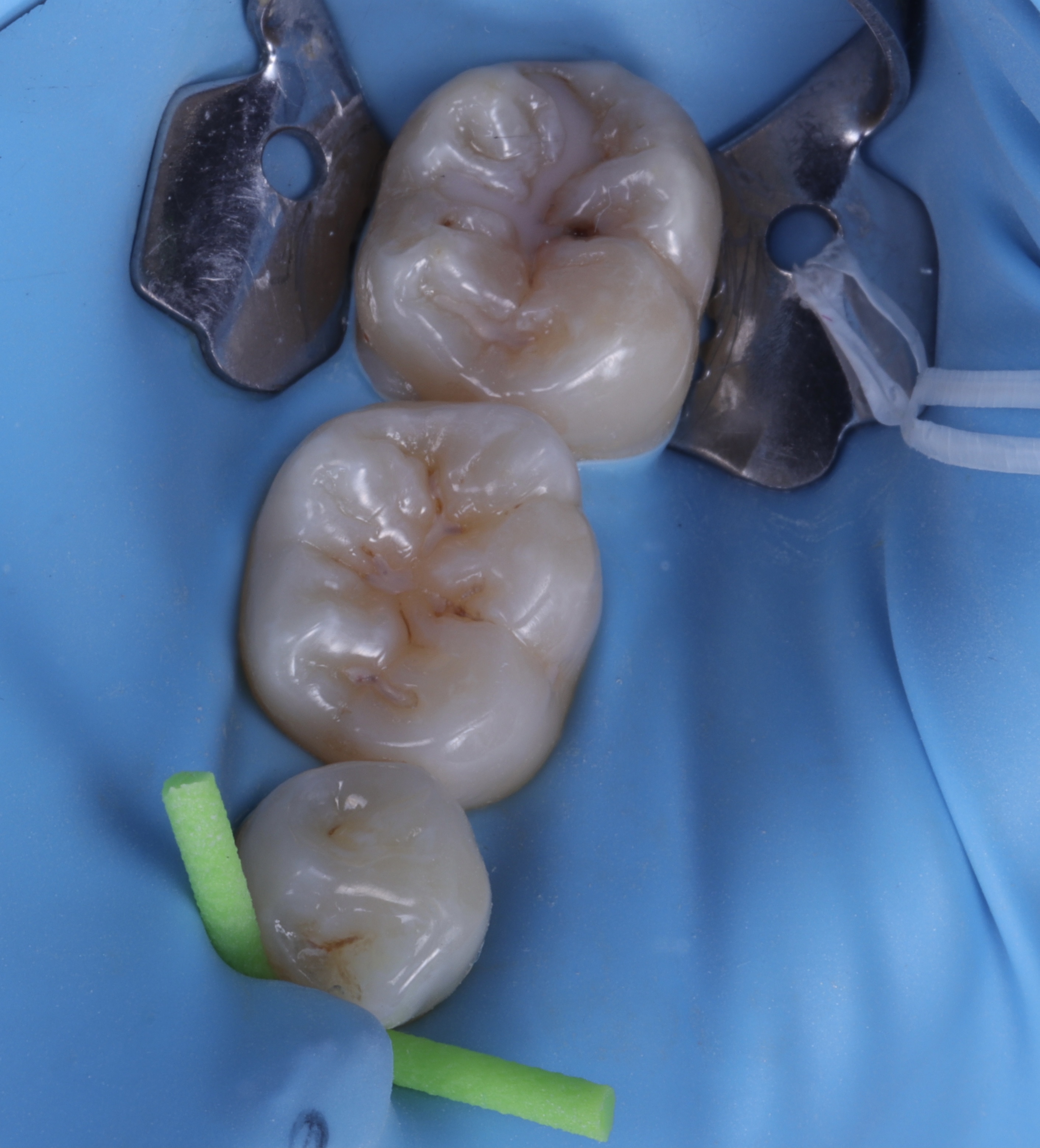 Rubber Dam... What is it and why it so important?! - Dental Practice